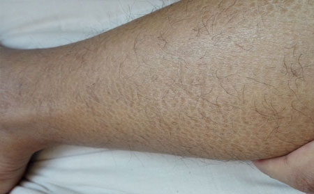 鱼鳞病患者失眠该怎么办