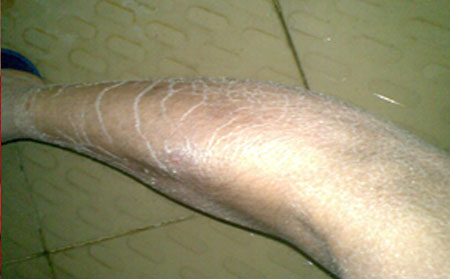 鱼鳞病患者可以吃什么