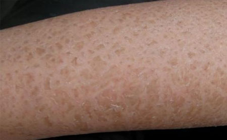 潍坊哪家医院治鱼鳞病比较好