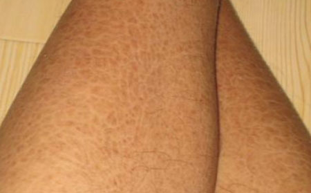 鱼鳞病用什么药,腿部鱼鳞病擦什么药