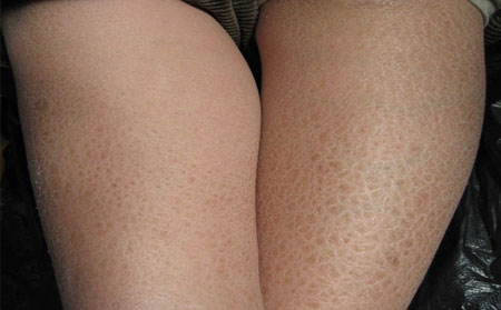 青少年鱼鳞病症状,青少年鱼鳞病常识