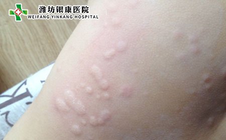 怎样预防皮肤过敏,皮肤过敏要怎样预防