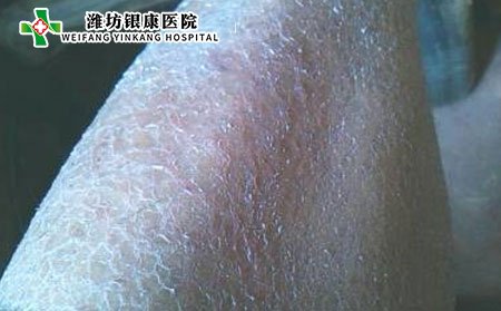 鱼鳞病怎样治,腿部鱼鳞病怎么治