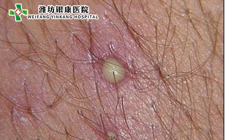 背部毛囊炎病因,为什么背部长毛囊炎