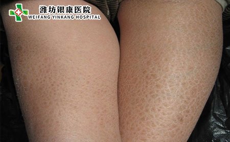 鱼鳞病症状,鱼鳞病有什么表现