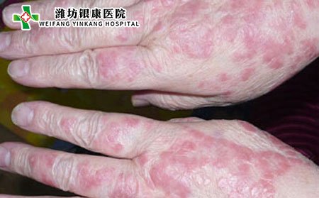 皮炎症状,轻度皮炎症状