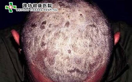 头癣传染吗,头癣会不会传染