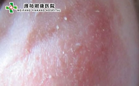 皮肤瘙痒,皮肤发痒原因