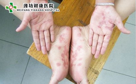 手足癣,手足癣护理,如何护理手足癣