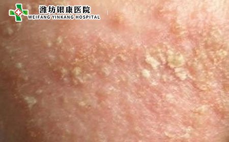 皮炎,皮炎传染吗