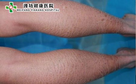 鱼鳞病,鱼鳞病症状,腿部鱼鳞病症状