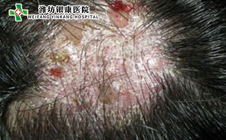 头癣,头癣会长到身上吗